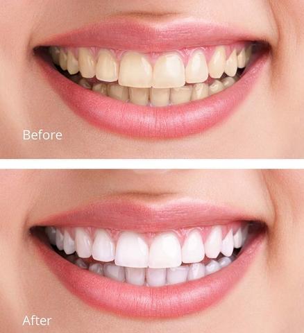 Vizzy Flawless Teeth Whitening Pen